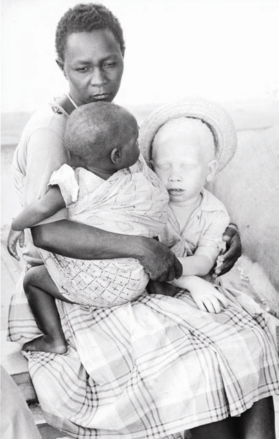 A woman with her two children, one of which is albino. Tanzania.
