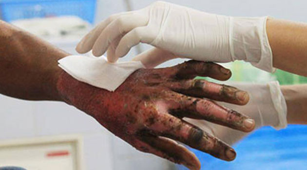 Burn incidents exceeded annual average in 2020: data
