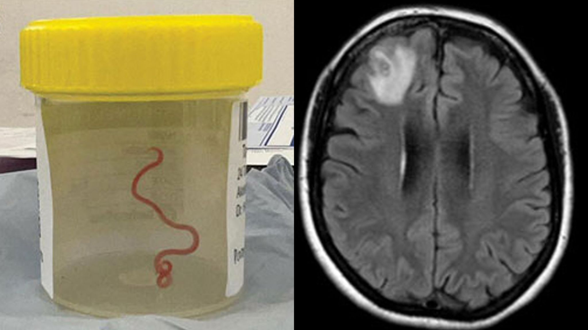 Live worm found in woman’s brain in Australia