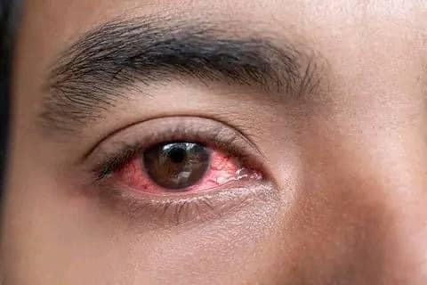 Conjunctivitis outbreak hits coastal Kenya
