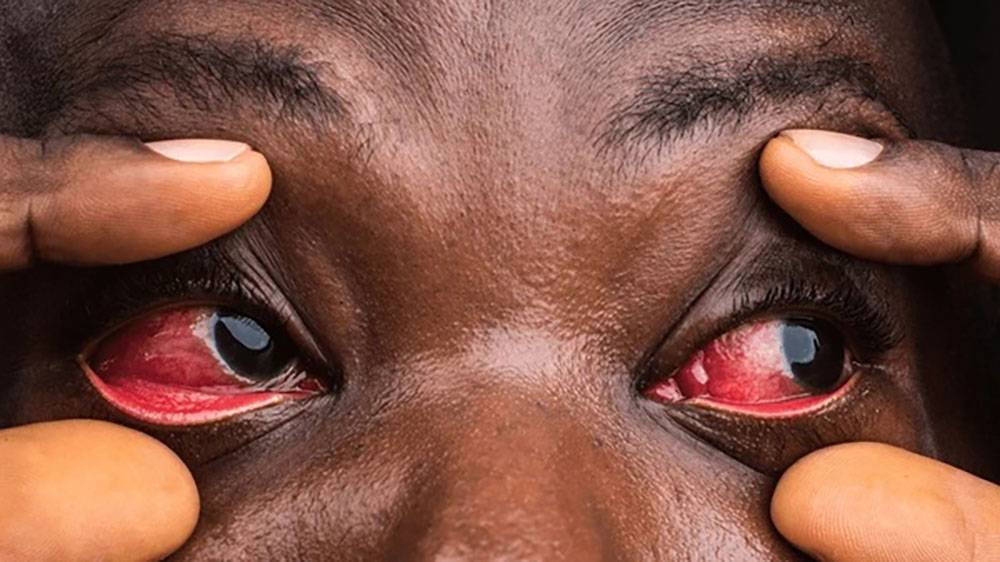 Silent Red-Eyes disease ravaging Busia citizens