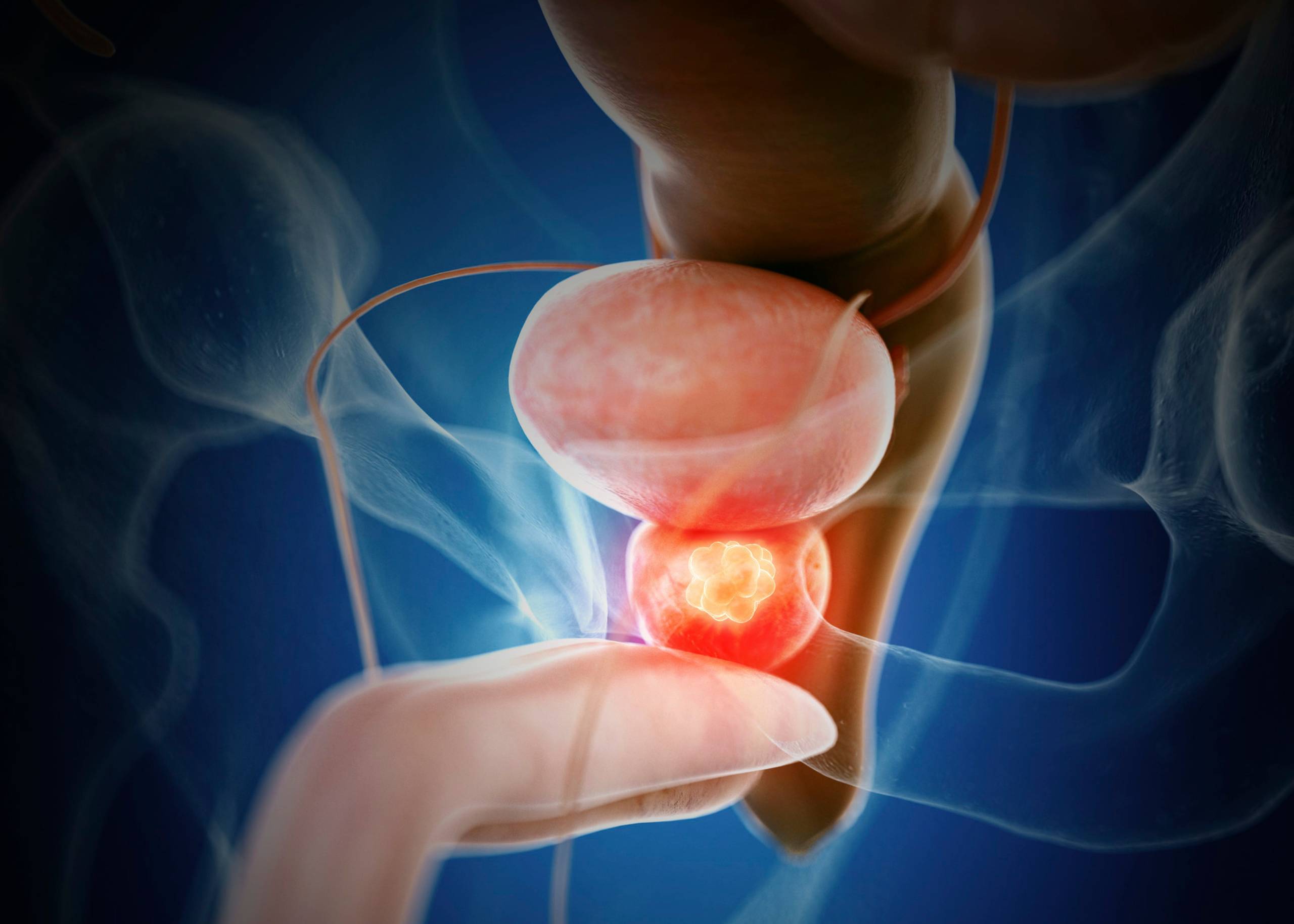 African men most at risk of prostate cancer – new study flags genetic causes